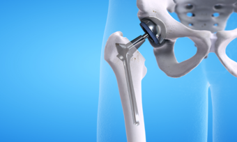 3D Metal hip replacement graphic