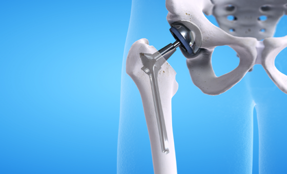 3D Metal hip replacement graphic